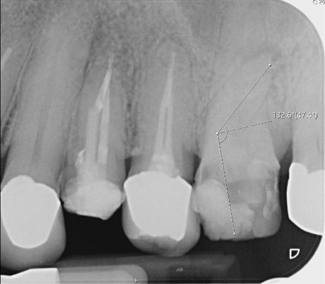 Molar endodontics - Pre-op case 4